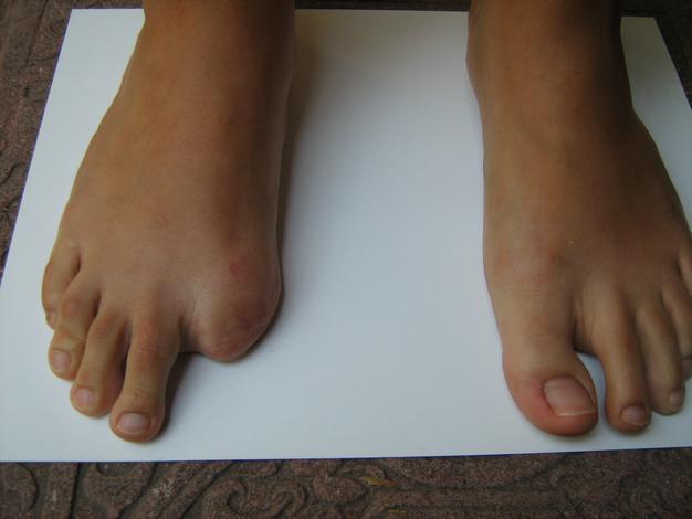 Prótesis de dedo del pie