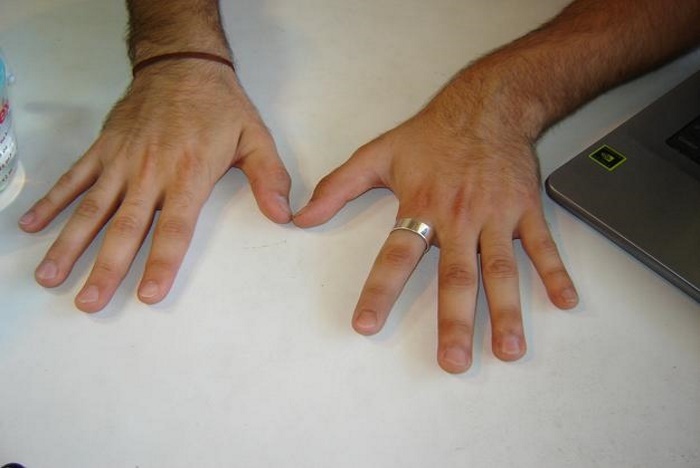 Prótesis de dedo