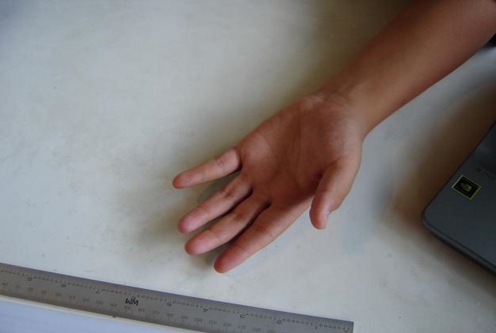 Prótesis dedo