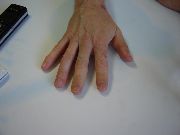 Prótesis de dedo