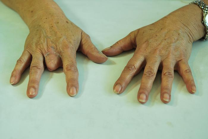 Prótesis dedo