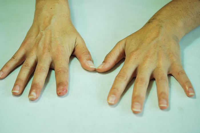 Protesis dedo