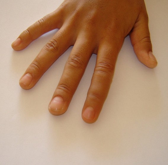 index finger prosthesis