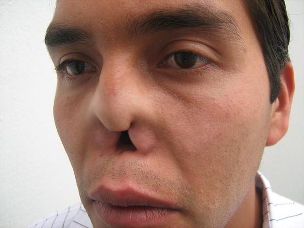 Prótesis de nasal