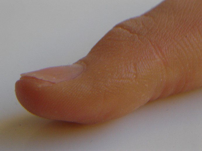 Protesis dedo pulgar3