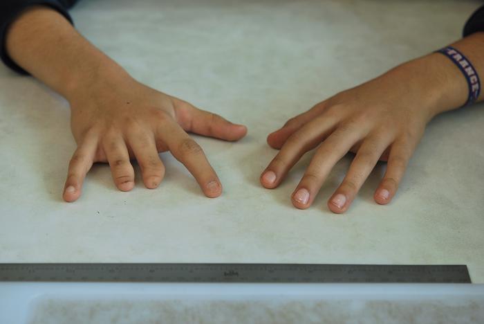 dedos prostetico