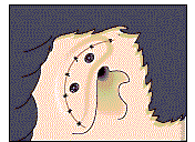 earlobe prosthetic procedure animation