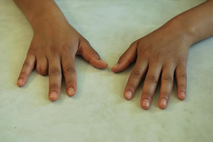 Prótesis para dedo