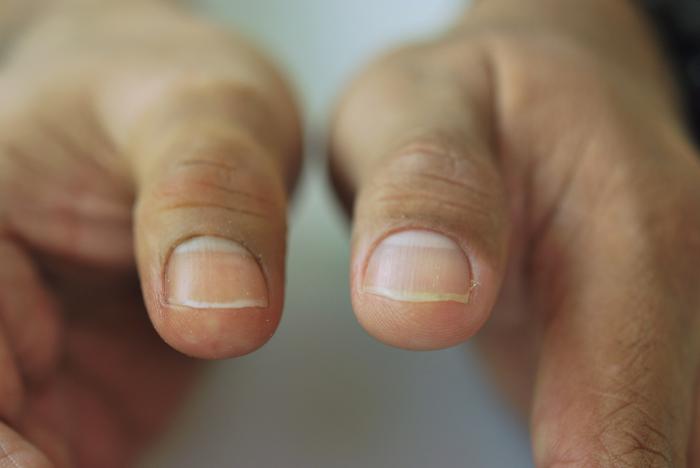 protesis para dedo