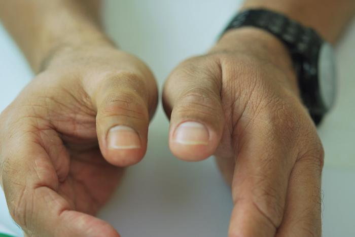 dedo prostetico