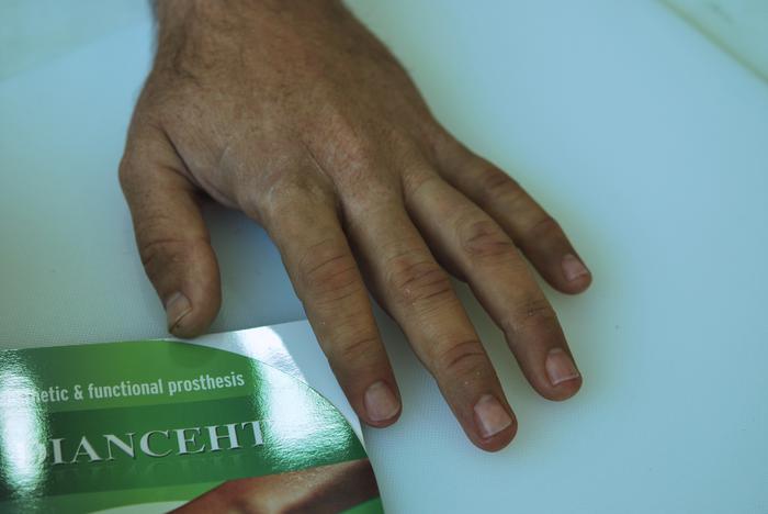 protesis para dedo, finger prosthesis