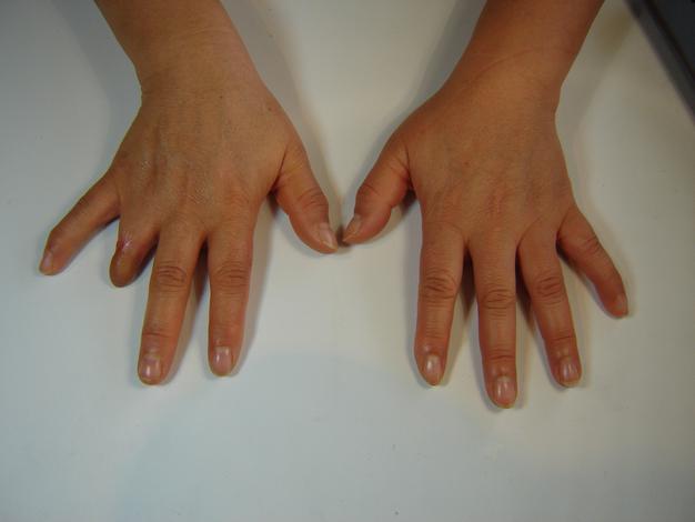 Prótesis para dedo