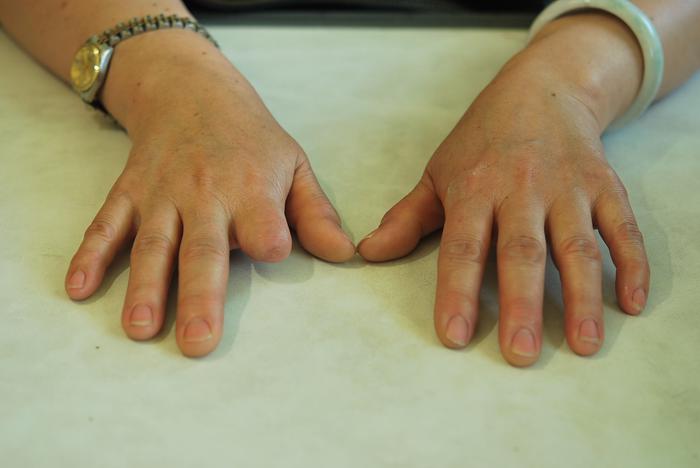 Finger prosthesis