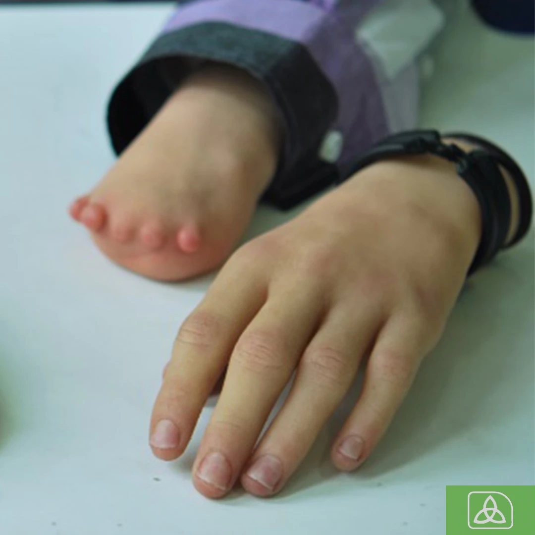 Complete hand prosthesis of a little girl next to her real stump.