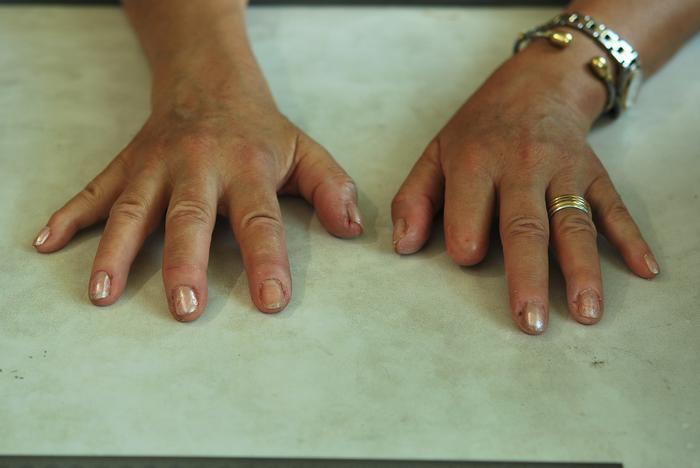 Finger prosthesis