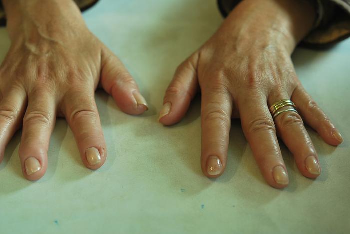 Finger prosthesis