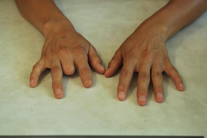 Finger prosthesis