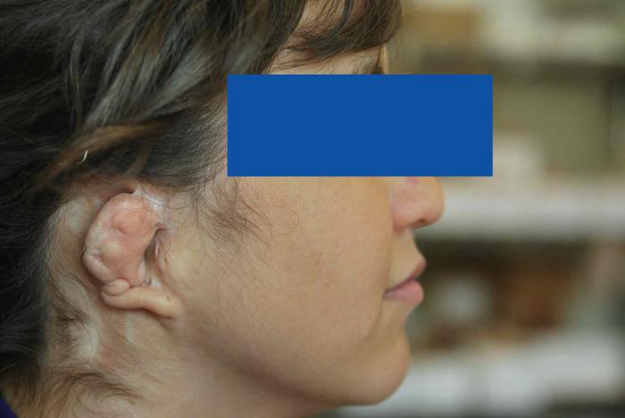 Prótesis para microtia