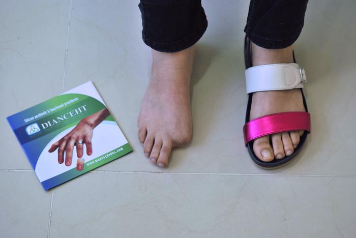 protesis para pie, foot prothesis