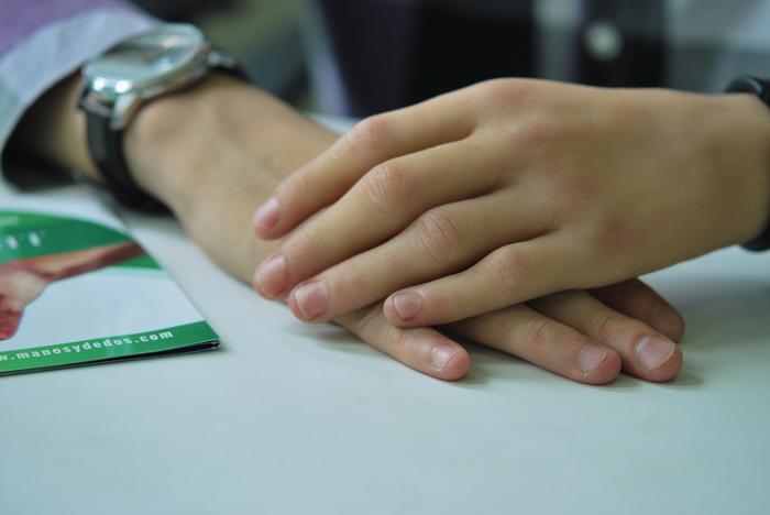 protesis para mano, hand prosthesis