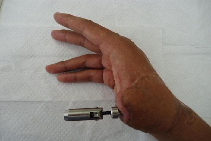 Prosthetic finger