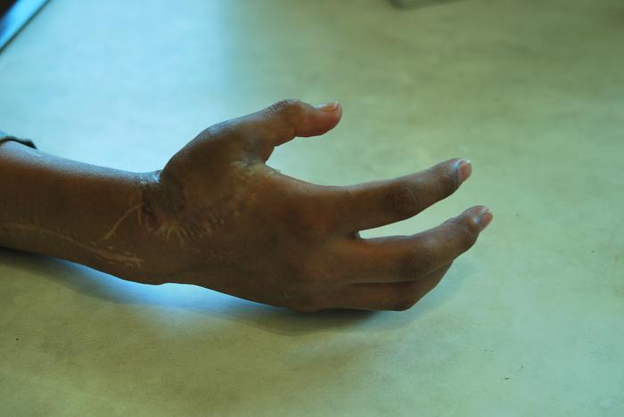 Prosthetic finger