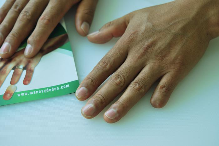 pinky finger prosthesis