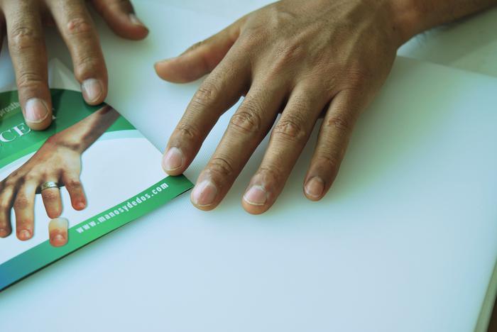 pinky finger prosthesis