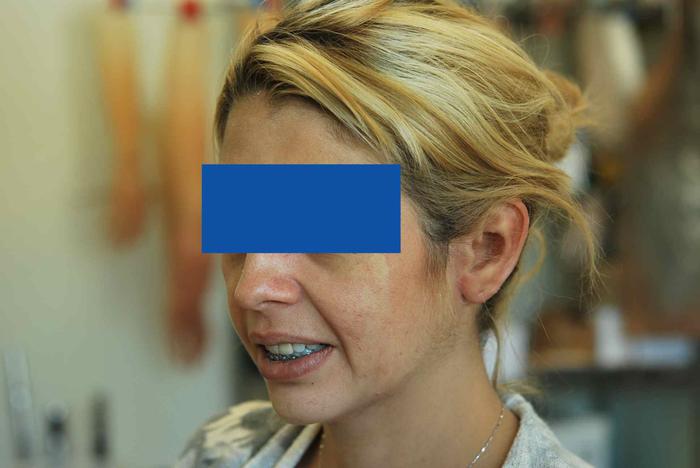 Prótesis microtia